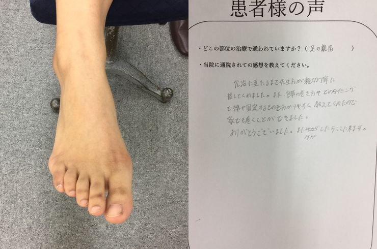 フランシア 親指