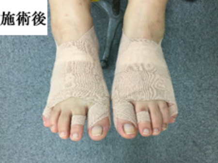 LP | 足の専門技術、外反母趾、足首捻挫、足底筋膜炎は戸塚小林