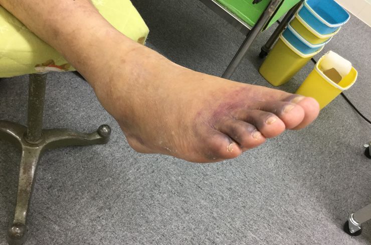 第五中足骨骨折 (2)